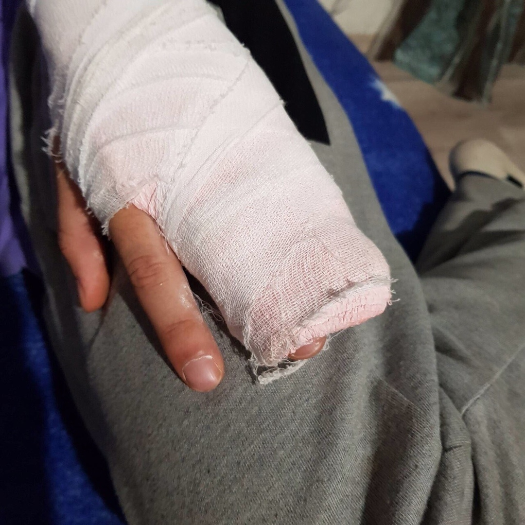 "Приходите через неделю": пензенский врач отправил мальчика с переломом домой